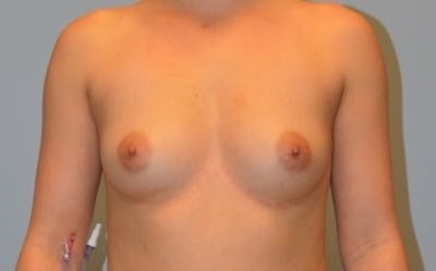 Breast Augmentation Before & After Gallery - Patient 358935 - Image 1