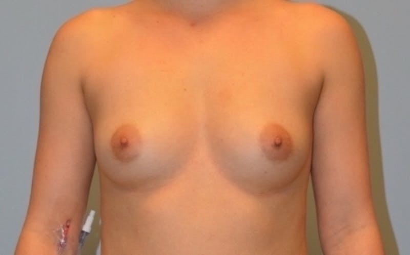 Breast Augmentation Before & After Gallery - Patient 358935 - Image 1