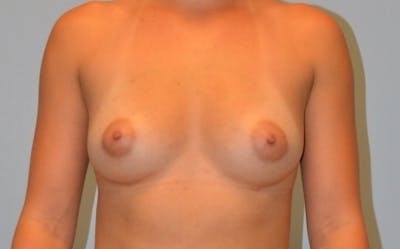 Breast Augmentation Before & After Gallery - Patient 358935 - Image 2