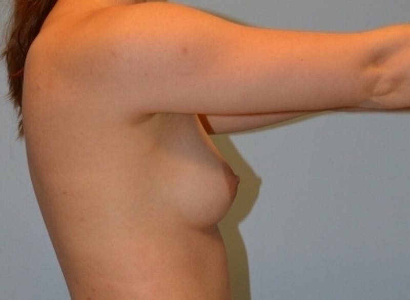 Breast Augmentation Before & After Gallery - Patient 358935 - Image 3