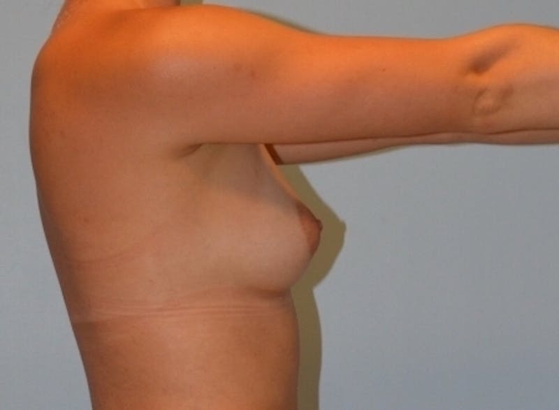 Breast Augmentation Before & After Gallery - Patient 358935 - Image 4