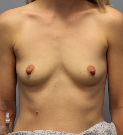 Breast Augmentation Before & After Gallery - Patient 162268 - Image 1