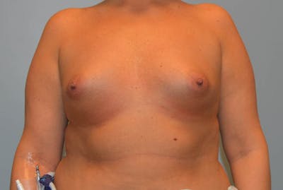 Breast Augmentation Before & After Gallery - Patient 327751 - Image 1