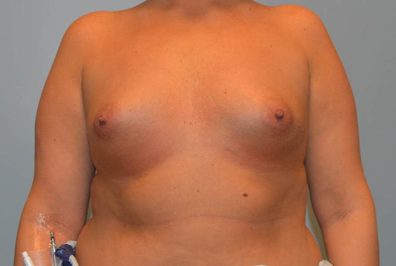Breast Augmentation Before & After Gallery - Patient 327751 - Image 1