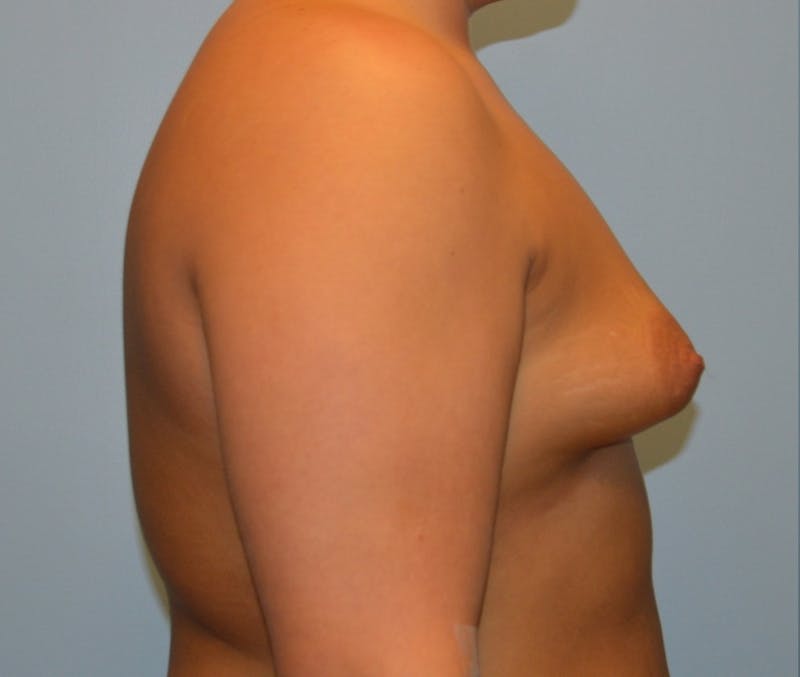 Breast Augmentation Before & After Gallery - Patient 291723 - Image 5