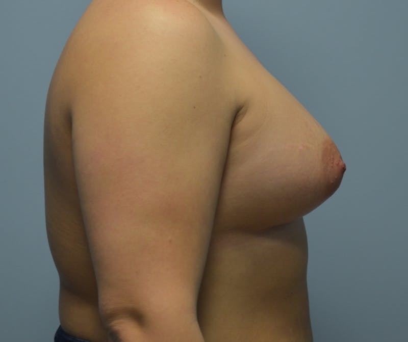 Breast Augmentation Before & After Gallery - Patient 291723 - Image 6