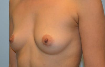 Breast Augmentation Before & After Gallery - Patient 107723 - Image 1