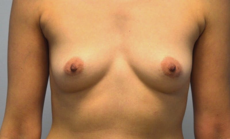Breast Augmentation Before & After Gallery - Patient 107723 - Image 3