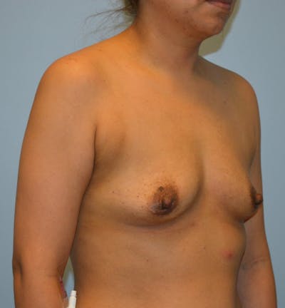 Breast Augmentation Before & After Gallery - Patient 766175 - Image 1