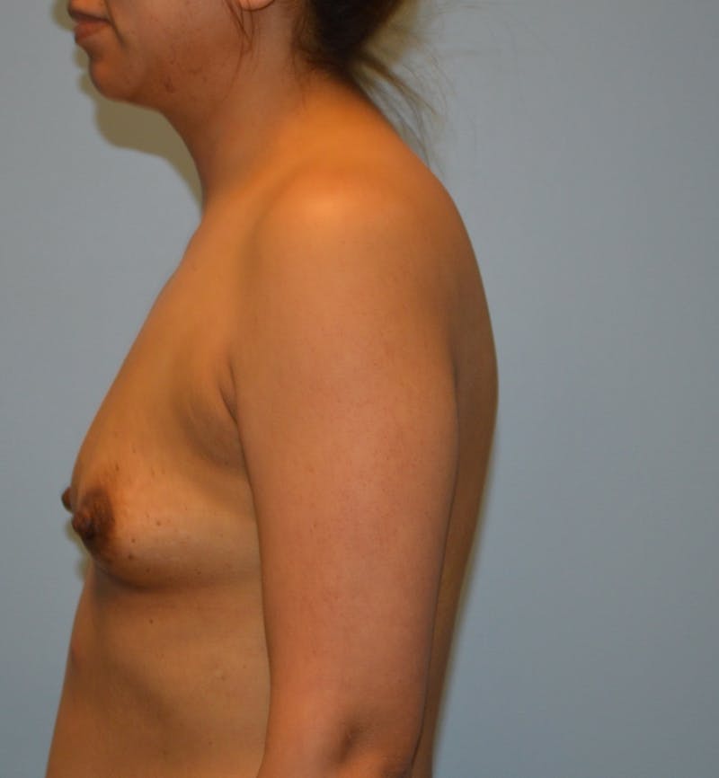 Breast Augmentation Before & After Gallery - Patient 766175 - Image 3