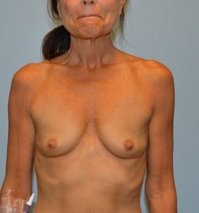 Breast Augmentation Before & After Gallery - Patient 406204 - Image 1