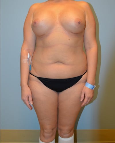 Liposuction Before & After Gallery - Patient 399763 - Image 1