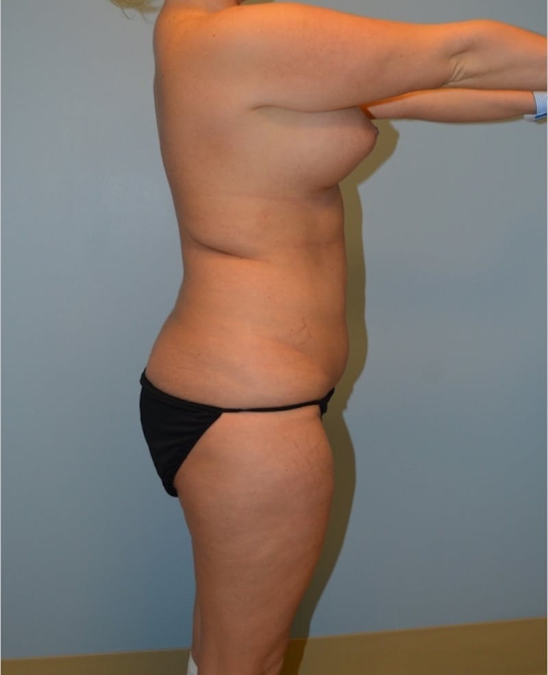 Liposuction Before & After Gallery - Patient 399763 - Image 3