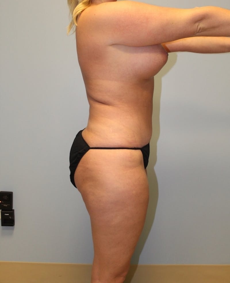 Liposuction Before & After Gallery - Patient 399763 - Image 4