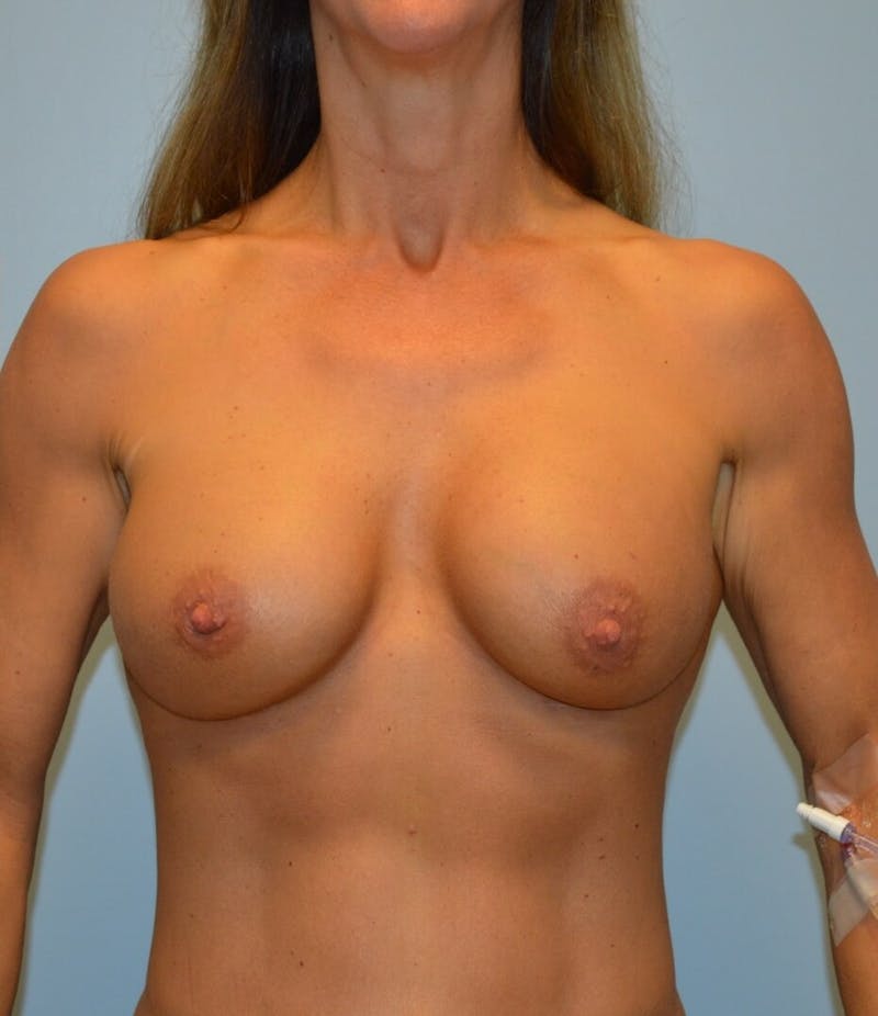 Breast Augmentation Before & After Gallery - Patient 154958 - Image 2