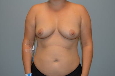 Breast Augmentation Before & After Gallery - Patient 279204 - Image 1