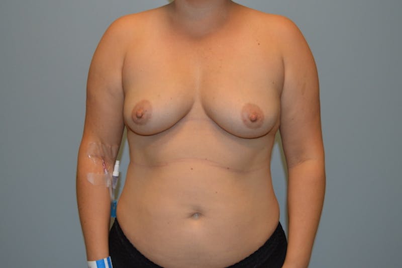 Breast Augmentation Before & After Gallery - Patient 279204 - Image 1