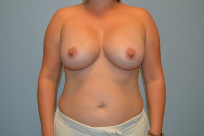 Breast Augmentation Before & After Gallery - Patient 279204 - Image 2