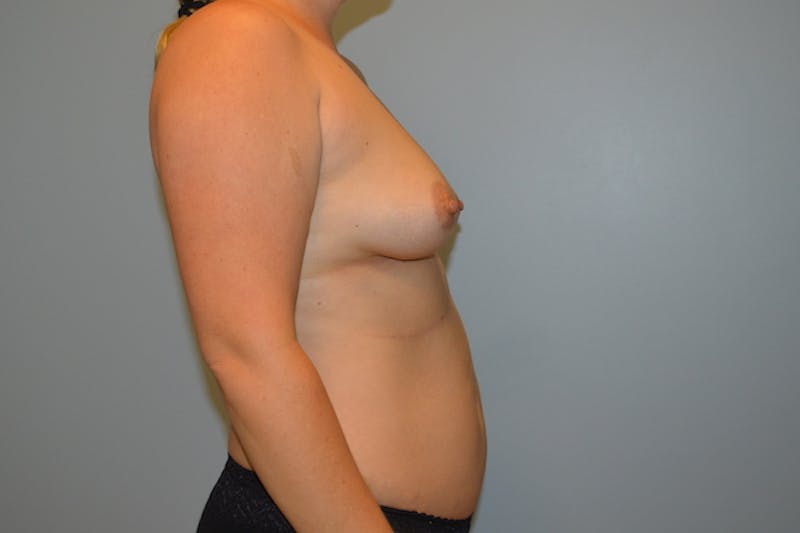 Breast Augmentation Before & After Gallery - Patient 279204 - Image 5