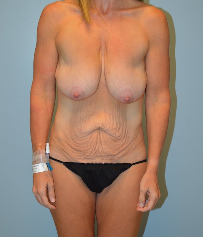 Liposuction Before & After Gallery - Patient 378419 - Image 1