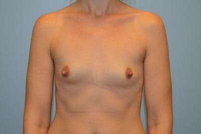 Breast Augmentation Before & After Gallery - Patient 505103 - Image 1