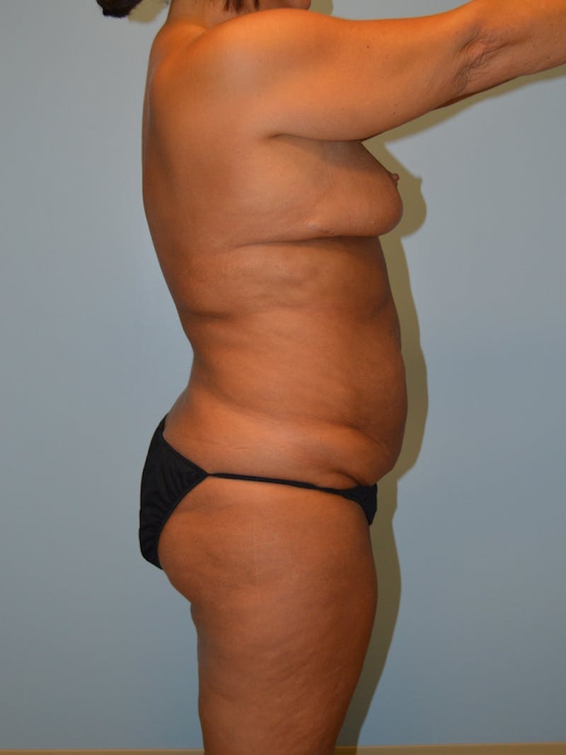 Liposuction Before & After Gallery - Patient 171071 - Image 3