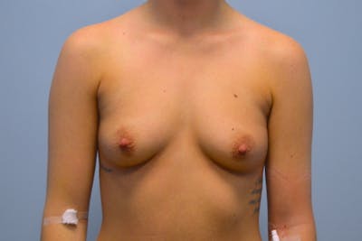 Breast Augmentation Before & After Gallery - Patient 165645 - Image 1