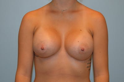 Breast Augmentation Before & After Gallery - Patient 165645 - Image 2