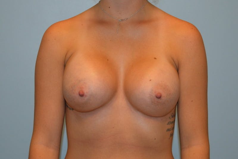 Breast Augmentation Before & After Gallery - Patient 165645 - Image 2