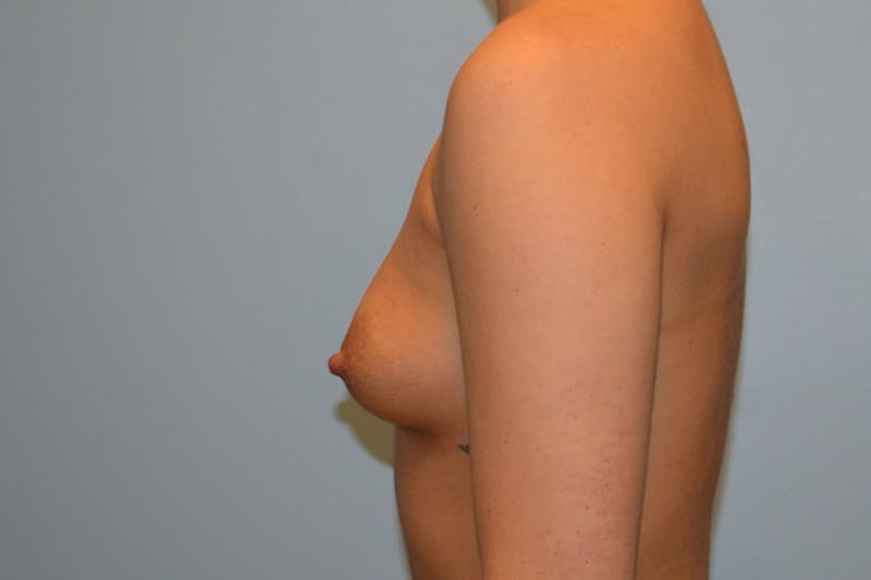Breast Augmentation Before & After Gallery - Patient 165645 - Image 5