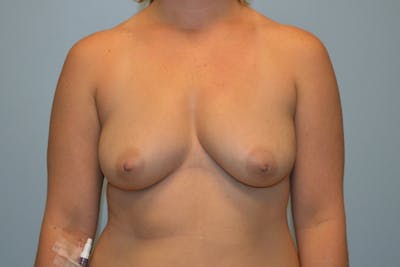 Breast Augmentation Before & After Gallery - Patient 152808 - Image 1