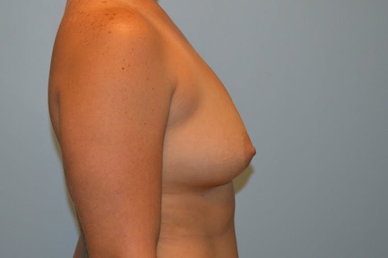 Breast Augmentation Before & After Gallery - Patient 152808 - Image 3