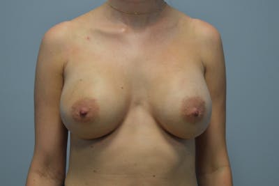 Breast Augmentation Before & After Gallery - Patient 176793 - Image 2