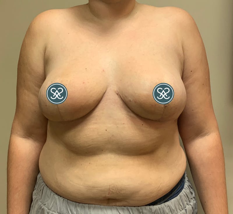 Breast Reduction Before & After Gallery - Patient 407768 - Image 2