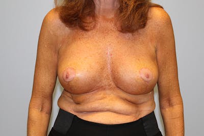 Breast Lift Before & After Gallery - Patient 550049 - Image 2