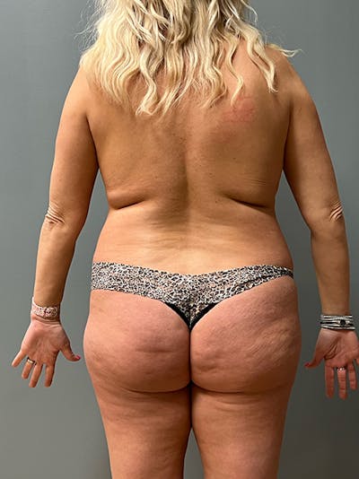 Brazilian Butt Lift Before & After Gallery - Patient 217054 - Image 1