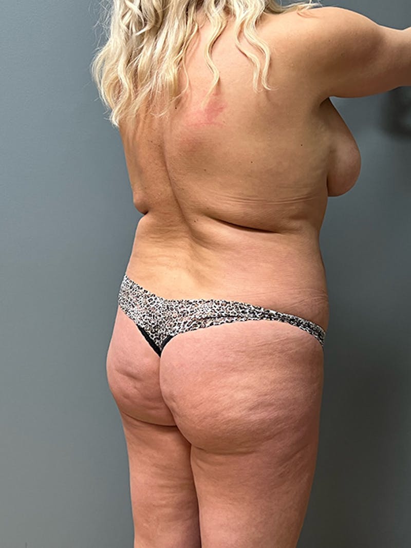 Brazilian Butt Lift Before & After Gallery - Patient 217054 - Image 3