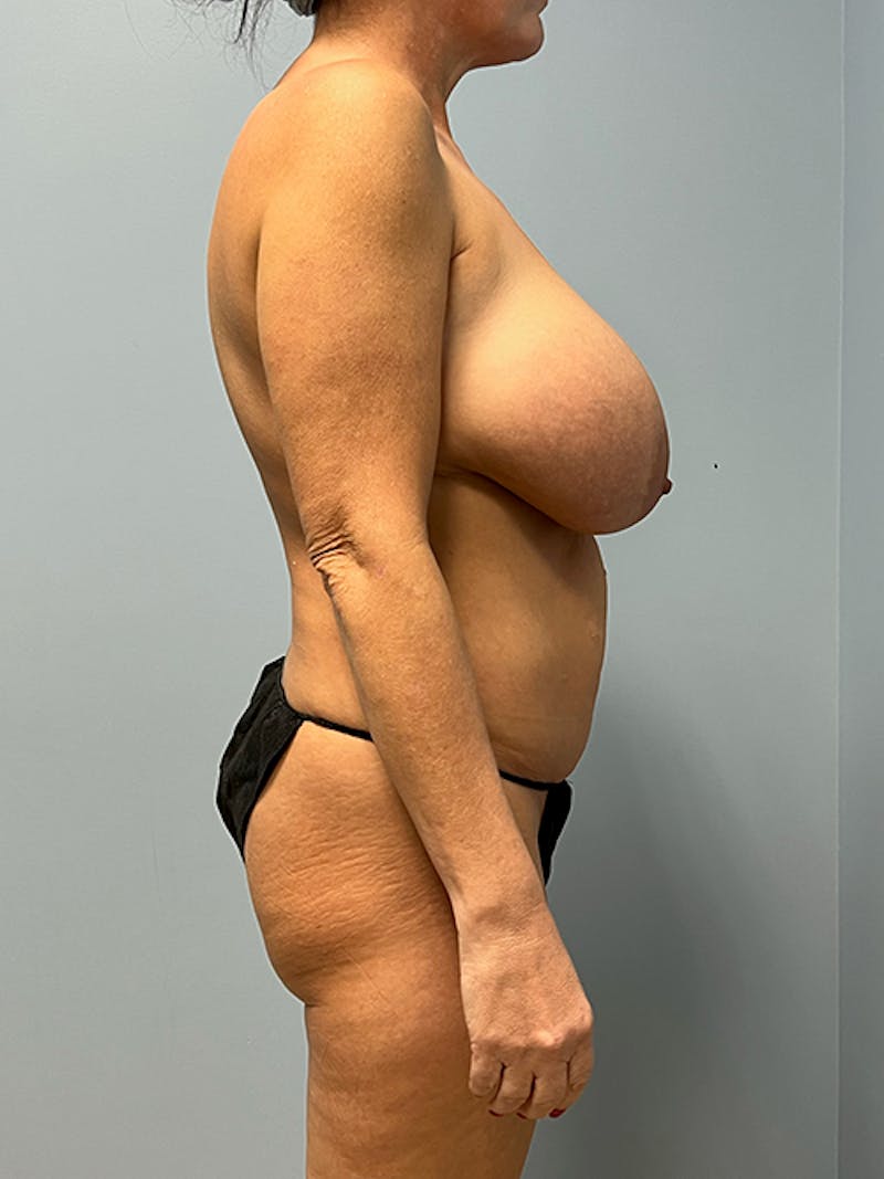Breast Reduction Before & After Gallery - Patient 106492 - Image 5