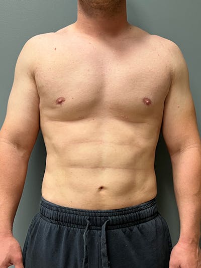 High Definition Men Before & After Gallery - Patient 839422 - Image 2
