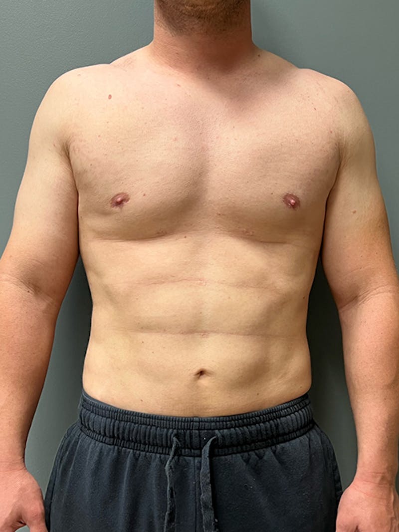 High Definition Men Before & After Gallery - Patient 839422 - Image 2