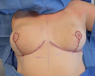 Breast Reduction Before & After Gallery - Patient 258969 - Image 2