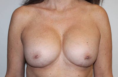 Corrective Breast Procedures Before & After Gallery - Patient 790121 - Image 1