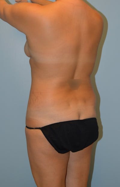 Brazilian Butt Lift Before & After Gallery - Patient 186519 - Image 1
