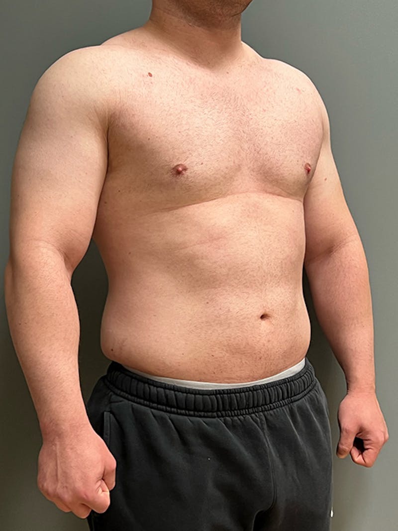 High Definition Men Before & After Gallery - Patient 839422 - Image 3