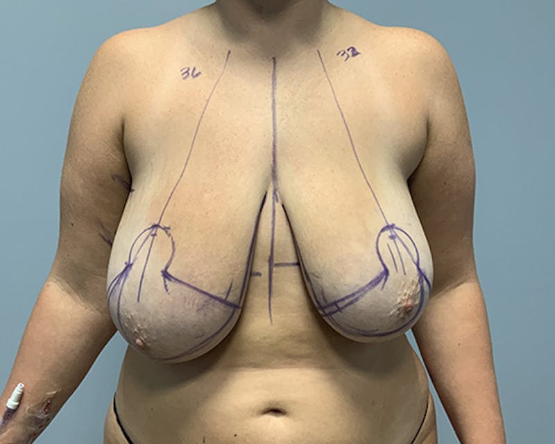 Breast Reduction Before & After Gallery - Patient 258969 - Image 3