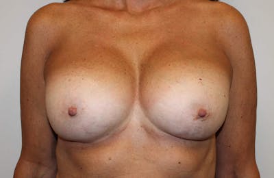 Corrective Breast Procedures Before & After Gallery - Patient 790121 - Image 2