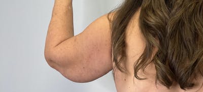 Arm Lift (Scarless Arm Lift) Before & After Gallery - Patient 203515 - Image 1