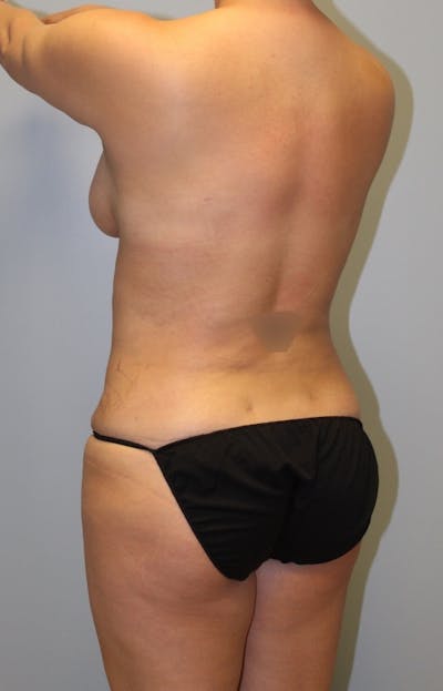 Brazilian Butt Lift Before & After Gallery - Patient 186519 - Image 2