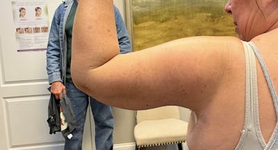Arm Lift (Scarless Arm Lift) Before & After Gallery - Patient 203515 - Image 2