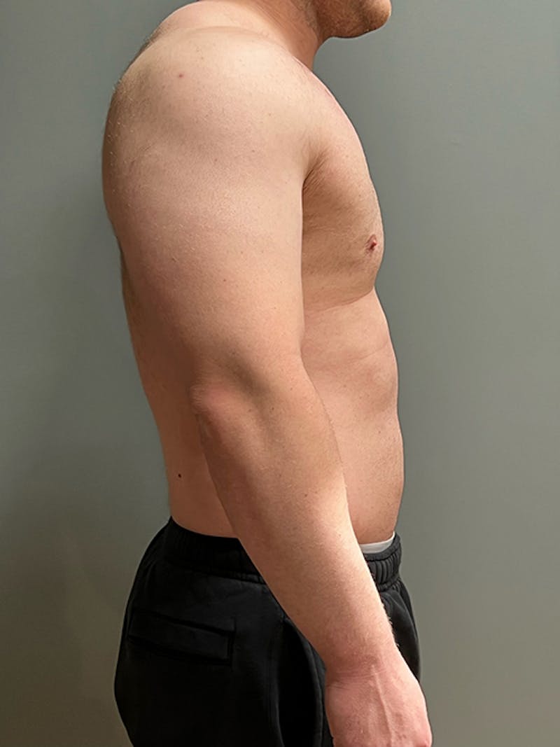 High Definition Men Before & After Gallery - Patient 839422 - Image 5